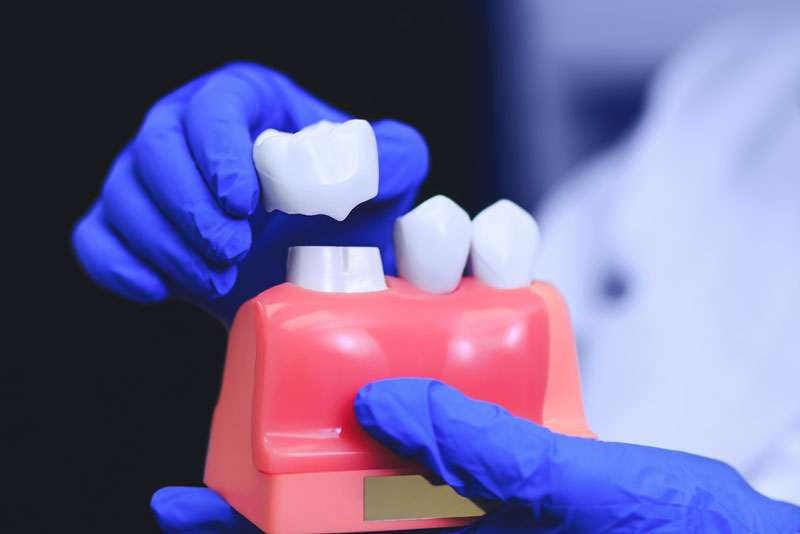 dental crowns model