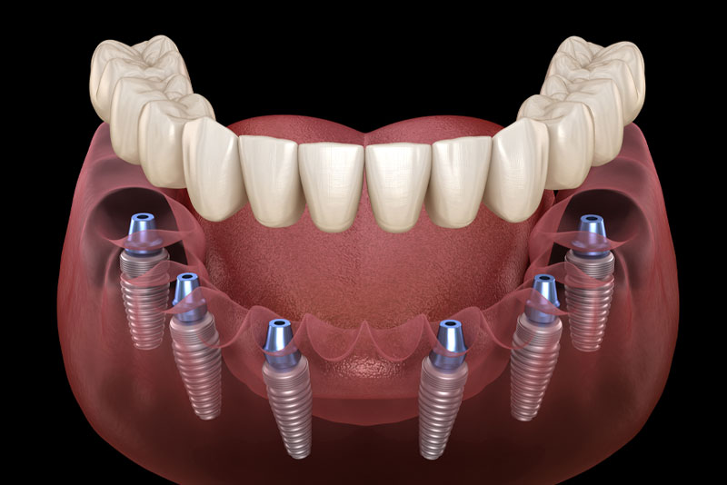 full mouth dental implants model